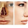 Искривление носовой перегородки — причины, симптомы, лечение