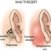 Мастоидит Заболевания уха, горла и носа