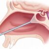 Операция на лобной пазухе — фронтотомия
